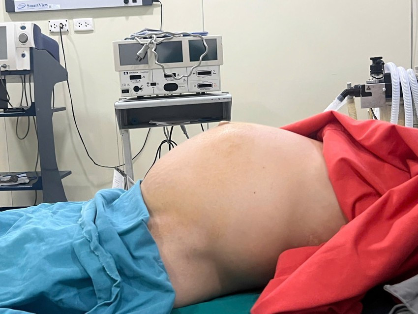 Người phụ nữ mang khối u xơ tử cung nặng gần 10 kg, phát triển suốt 10 năm, khiến bụng bệnh nhân phình to như mang thai đủ tháng. Ảnh BV