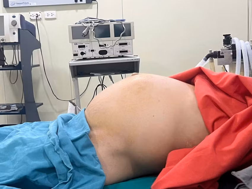 Người phụ nữ mang khối u xơ tử cung nặng gần 10 kg, phát triển suốt 10 năm, khiến bụng bệnh nhân phình to như mang thai đủ tháng. Ảnh BV