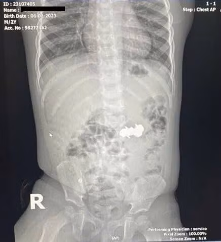 Bé trai nuốt 4 viên đinh nam châm đầu nhọn nguy hiểm. Ảnh BV