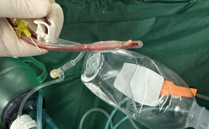 Thức ăn bám vào ống nội soi đường thở sau khi nỗ lực cứu chữa của bác sĩ thất bại (ảnh: BSCC/nguồn tienphong.vn)