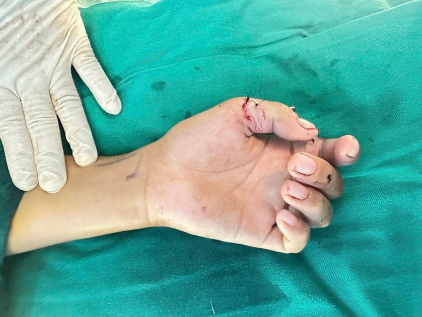 Bé trai 12 tuổi nghịch dao cắt cỏ dẫn đến đứt lìa 2 ngón tay. Ảnh: BVCC