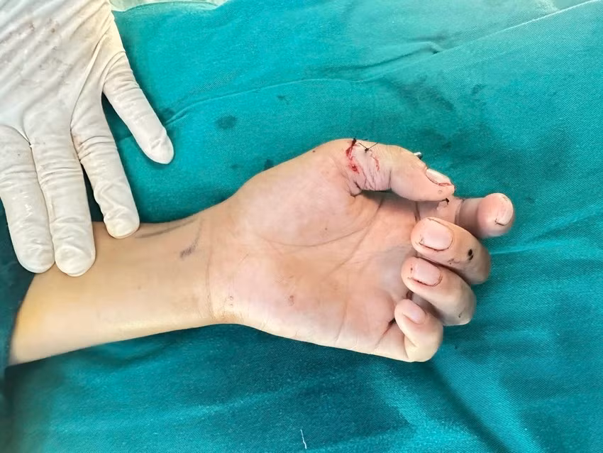 Bé trai 12 tuổi nghịch dao cắt cỏ dẫn đến đứt lìa 2 ngón tay. Ảnh: BVCC