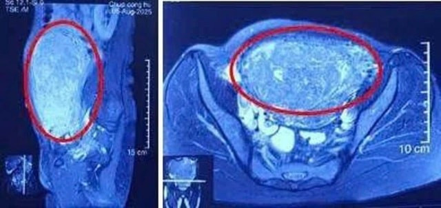 Khối u lớn chiếm gần trọn ổ bụng dưới, khiến người bệnh trông như đang mang song thai ở tháng cuối. Ảnh BV