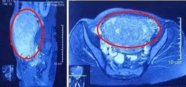 Khối u lớn chiếm gần trọn ổ bụng dưới, khiến người bệnh trông như đang mang song thai ở tháng cuối. Ảnh BV