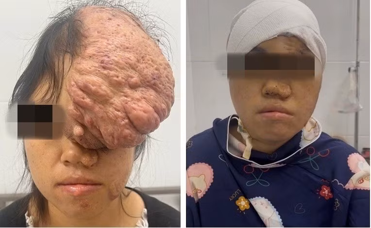 Hình ảnh gương mặt bệnh nhân trước và sau phẫu thuật