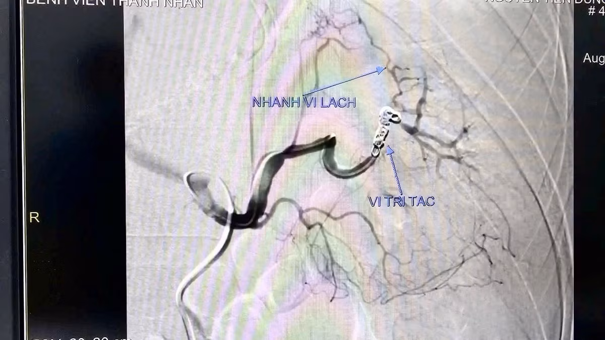 Hình ảnh chụp động mạch lách của bệnh nhân. Ảnh BV