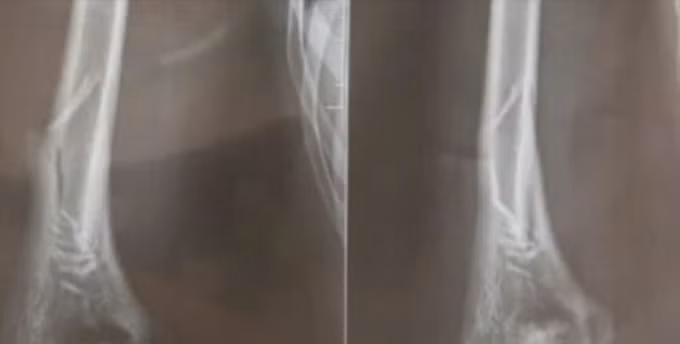 Hình ảnh chụp X-quang nam thanh niên 18 tuổi gãy tay khi chơi vật tay. Ảnh: Bệnh viện cung cấp