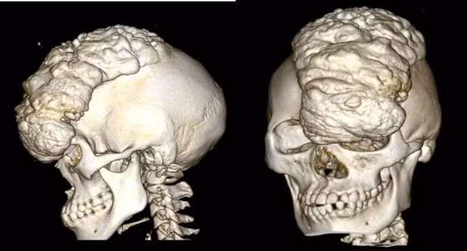 Hình ảnh khối u khổng lồ vùng đỉnh trán trước phẫu thuật. Ảnh: SYT