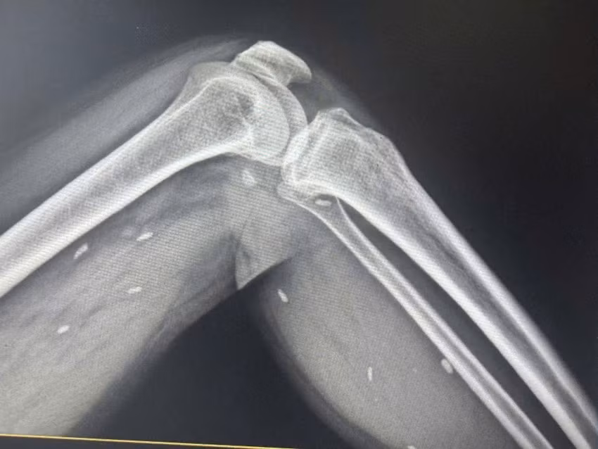 Nhiều kén sán nằm trong mô vùng xương đùi và cẳng chân bệnh nhân/Ảnh plo.vn