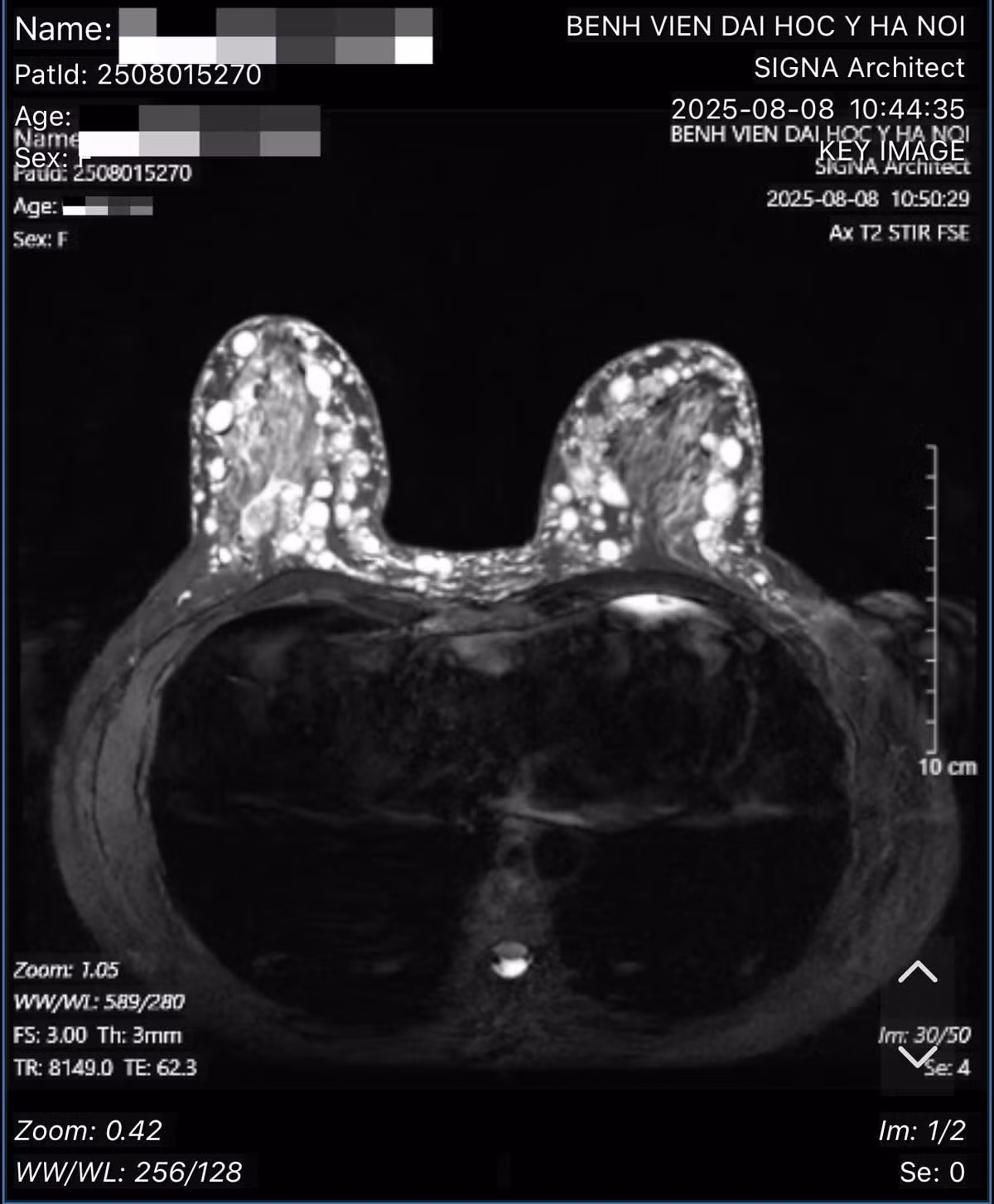 Hình ảnh các hạt sillicone tại ngực bệnh nhân. Ảnh BSCC/Nguồn daibieunhandan.vn