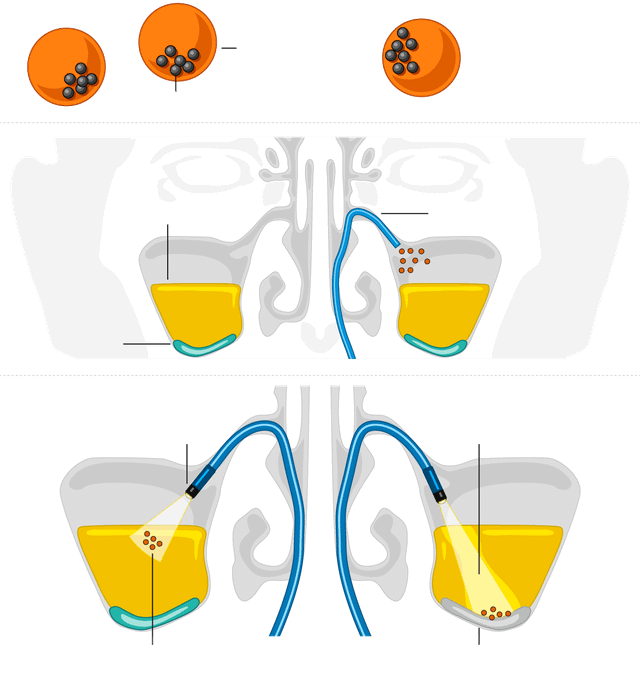 Cơ chế hoạt động của vi robot điều trị viêm xoang sinus-microrobots-inarticle-620.png