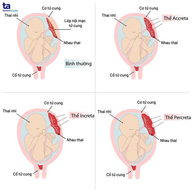Các thể bệnh rau cài răng lược - Ảnh BVCC cac-the-nhau-cai-rang-luoc.jpg