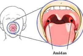 Hình ảnh amiđan và biểu hiện amiđan viêm - Ảnh minh họa BSCC anh-1.jpg