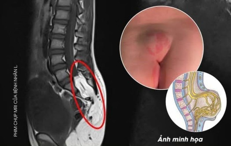 Thoát vị tủy - màng tủy có kèm theo khối mỡ hiếm gặp - Ảnh BVCC di-tat-hiem-gap-3079.jpg