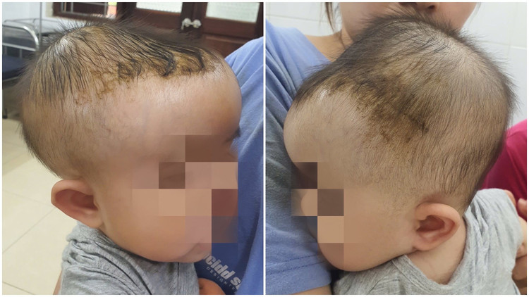 Máu tụ ở đầu bé - Ảnh BVCC nga-giuong.jpg