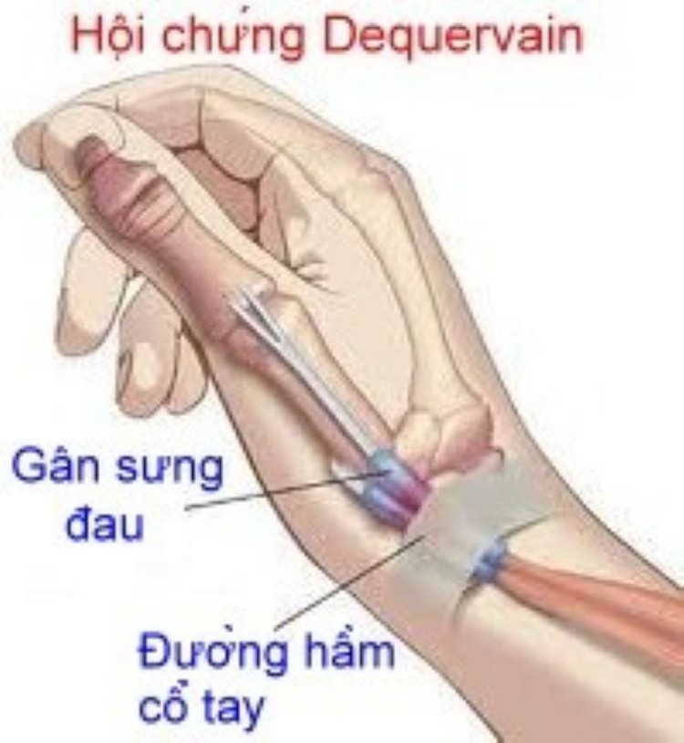 hội chứng De Quervain - Ảnh BSCC anh-1.jpg