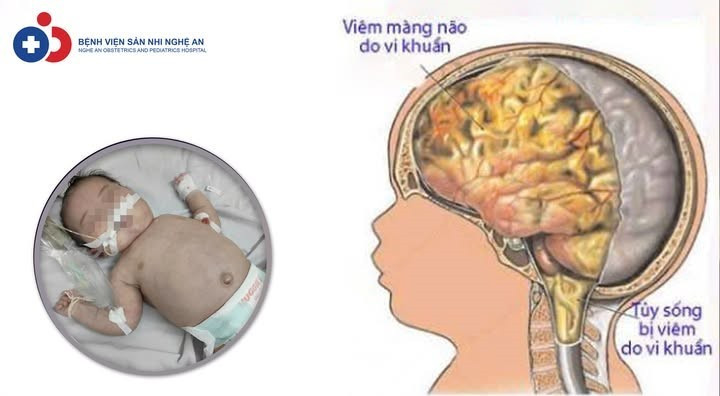 Trẻ mới 20 ngày tuổi đã bị viêm não mô cầu - Ảnh BVCC 505829312-1126538186176349-5036538241496101583-n.jpg