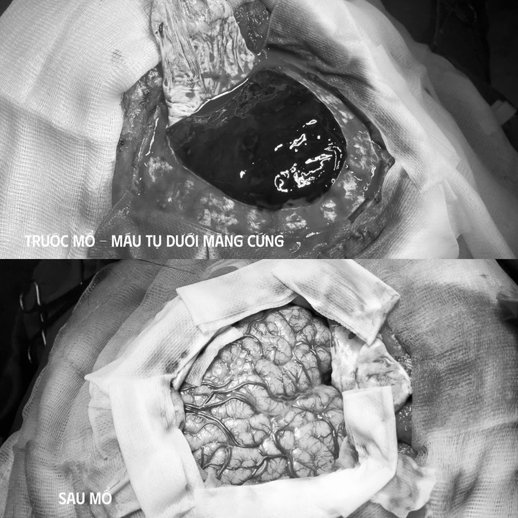 Khối máu tụ trong não trước và sau mổ - Ảnh BVCC mau-tu.jpg