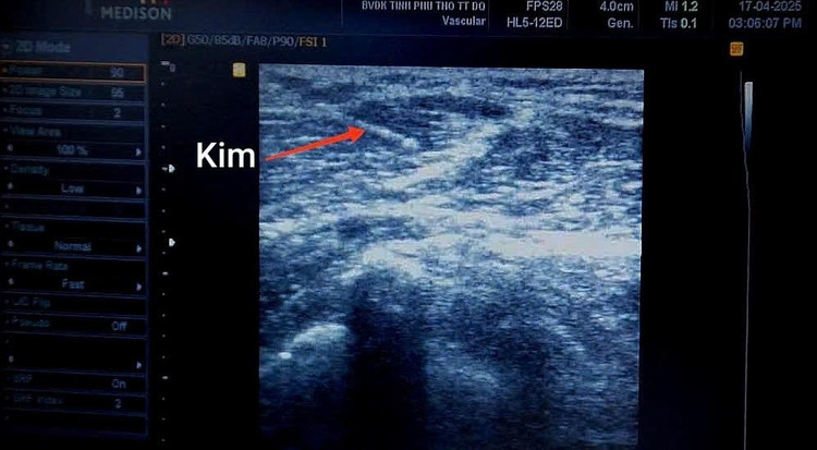 Botulinum toxin nhóm A (BoNT-A) - Hình ảnh kim và quá trình tiêm thuốc rõ ràng, chính xác dưới hướng dẫn siêu âm. co-cung-co-4.jpg