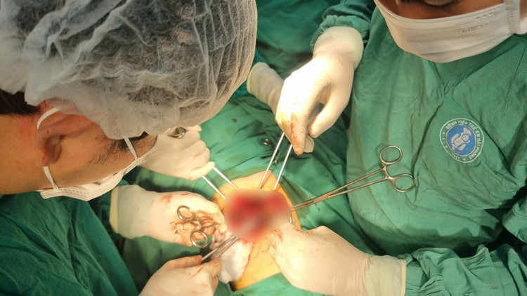 Ê- kíp phẫu thuật cho trẻ - Ảnh BVCC vo-gan-2.jpg