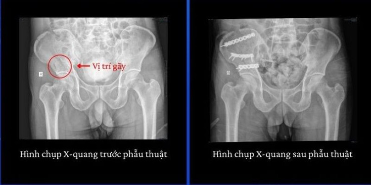 Hình ảnh CT của bệnh nhân - Ảnh BVCC nga-mai-nha.jpg