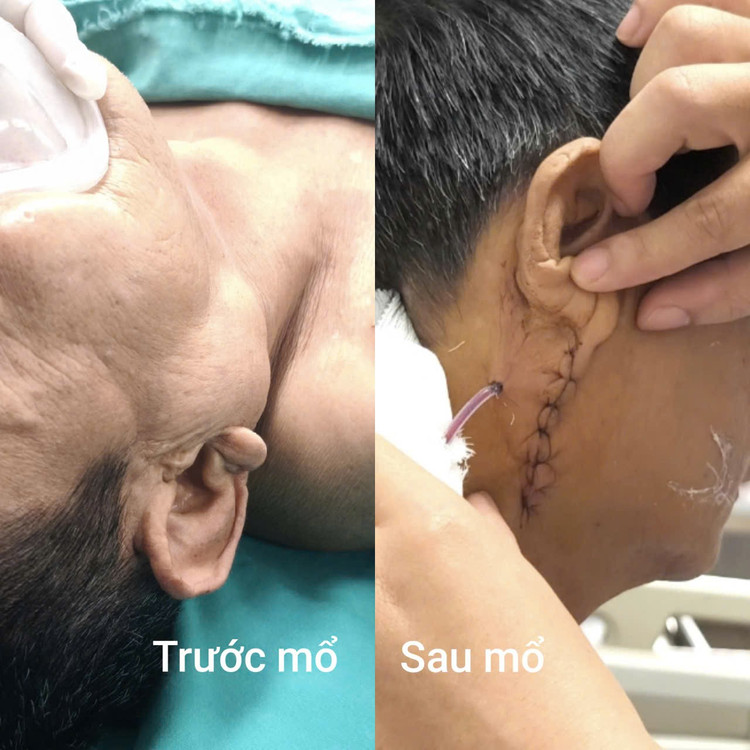 Hình ảnh khối u trước và sau mổ - Ảnh BVCC u-tuyen-nuoc-bot.jpg