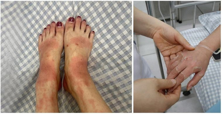 Hình ảnh bàn tay và bàn chân của người bệnh bị viêm da - Ảnh BVCC da-lieu-2.jpg