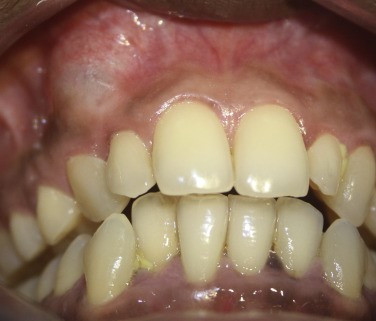 Nang xương hàm - Ảnh BSCC nang-xuong-ham-1.jpg