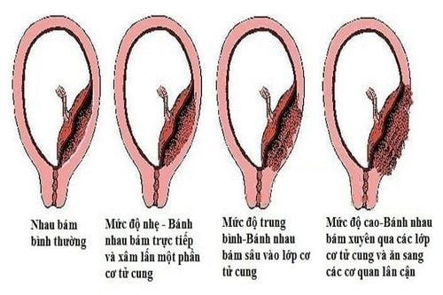 Các mức độ của rau cài răng lược - Ảnh minh họa nguồn Internet rau-cai.jpg