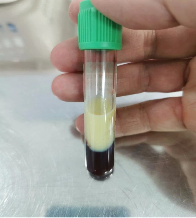 Máu trắng như sữa vì Triglycerid cao gấp nhiều lần - Ảnh BVCC mo-mau-tuy-cap.jpg