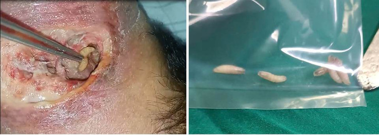 Hình ảnh giòi được gắp ra khỏi ổ hoại tử - Ảnh BVCC gioi-2.jpg