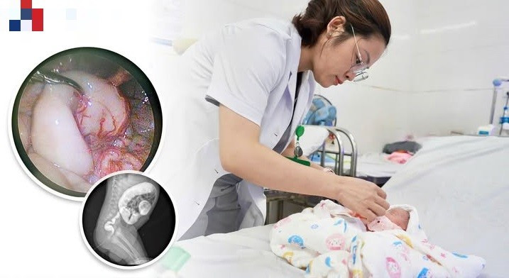 Bé 2,4 kg được phẫu thuật phình đại tràng bẩm sinh - Ảnh BVCC dai-trang-bam-sinh.jpg