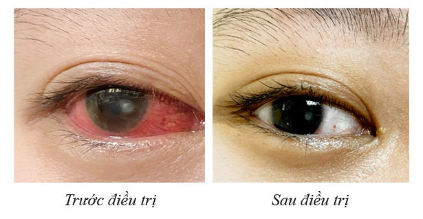 Hình ảnh mắt bệnh nhân trước điều trị sau điều trị' - Ảnh BVCC leoet-giac-mac.jpg