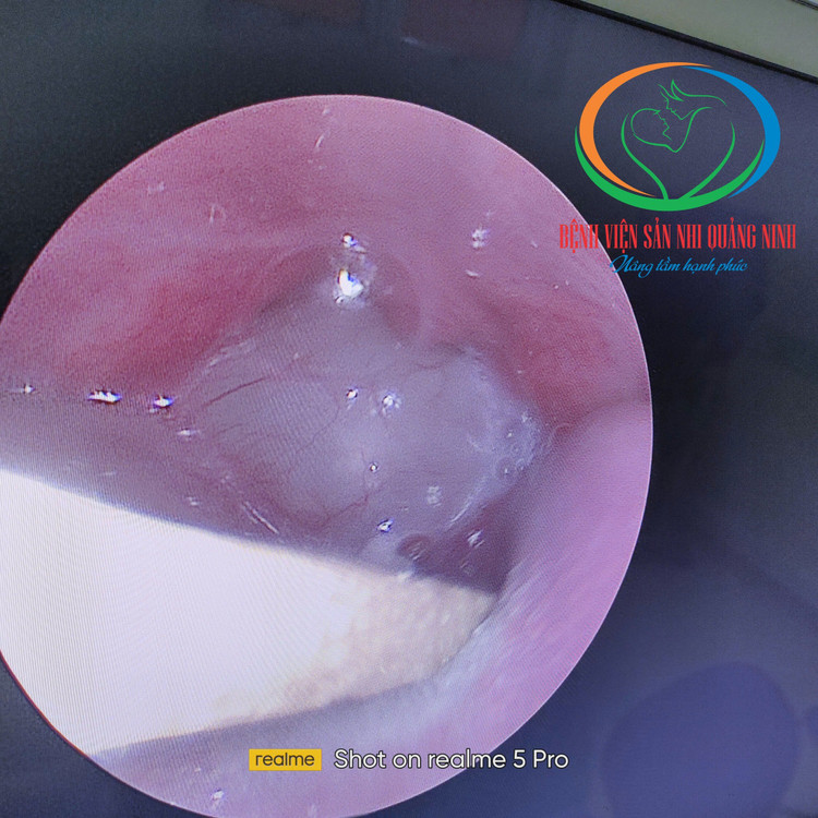 Hình ảnh nội soi khối u kích thước lớn - Ảnh BVCC san-u-5.jpg