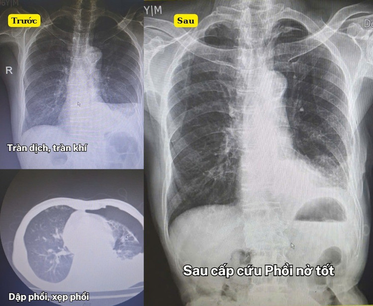 Hình ảnh chấn thương ở phổi của bệnh nhân trước và sau cấp cứu - Ảnh BVCC chan-thuong-1.jpg