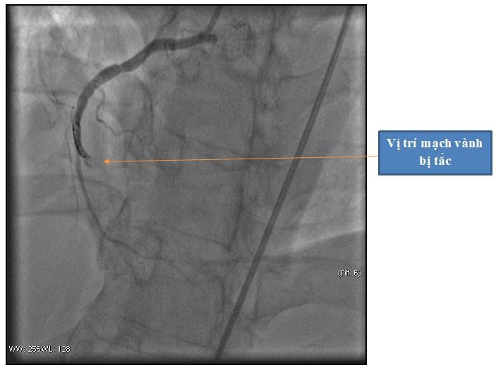 Hình ảnh động mạch vành phải bị tắc hoàn toàn - Ảnh BVCC ep-tim-1.jpg