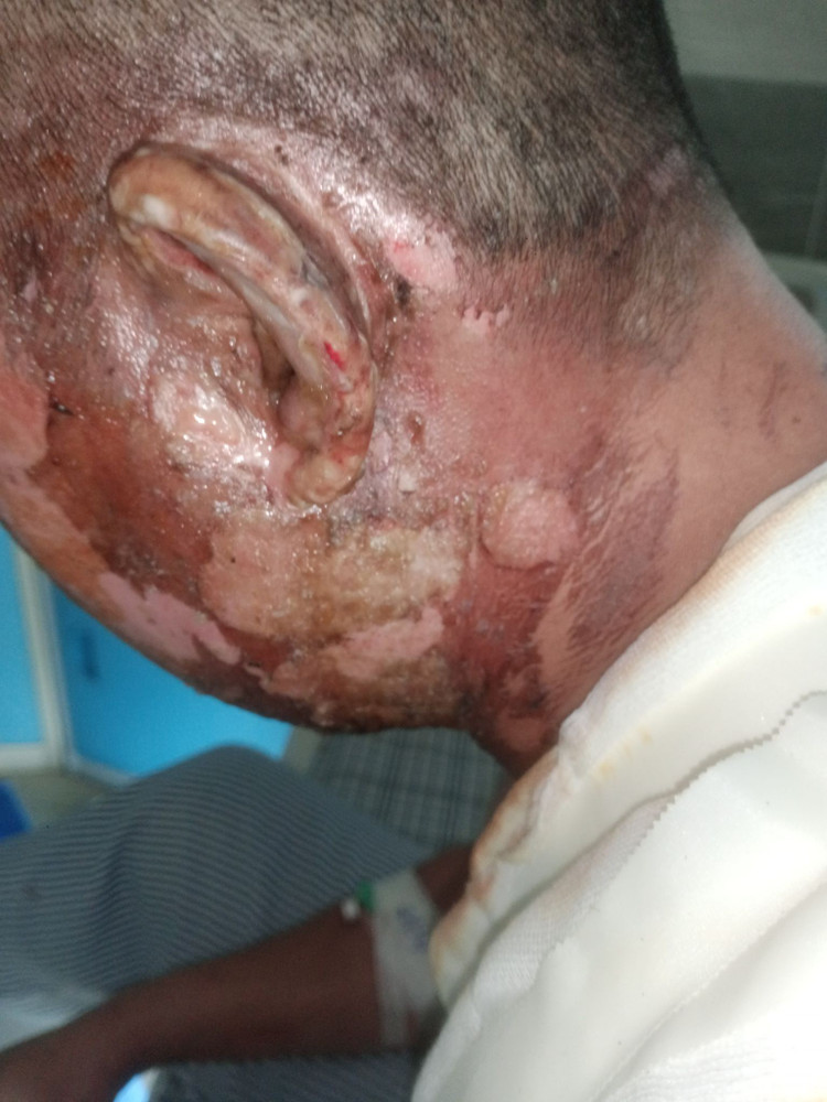 Tổn thương nghiêm trọng vùng mặt, cổ - Ảnh BVCC bong-lua-1.jpg
