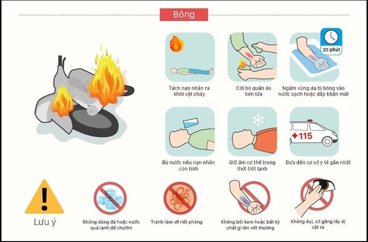 Cách xử lý khi bị bỏng - Hình minh họa BVCC bong-lua.jpg