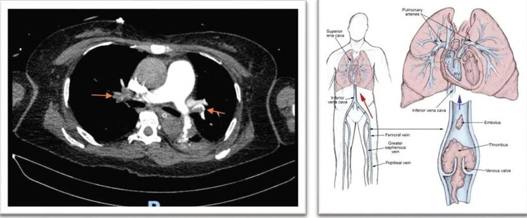 Kết quả CT-scan khẳng định thuyên tắc phổi cấp, do huyết khối từ tĩnh mạch sâu chân (T) di chuyển lên - Ảnh BVCC cr-1.jpg