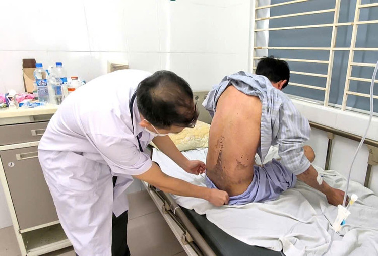 Tổn thương ở lưng của bệnh nhân - Ảnh BVCC bong-rat-3.jpg