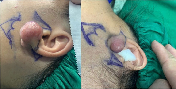 Hình ảnh dái tai kèm khối u được cắt bỏ triệt để hạn chế nguy cơ tái phát u-tai-2.jpg