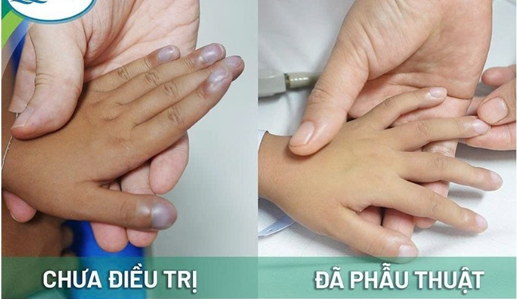 Tay của bệnh nhi trước và sau chữa trị - Ảnh BVCC tu-chan-5.jpg