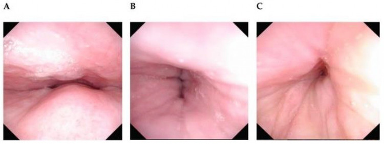 Nội soi can thiệp các điểm hẹp điều trị ngủ ngáy - Ảnh BVCC ngu-ngay-2.jpg