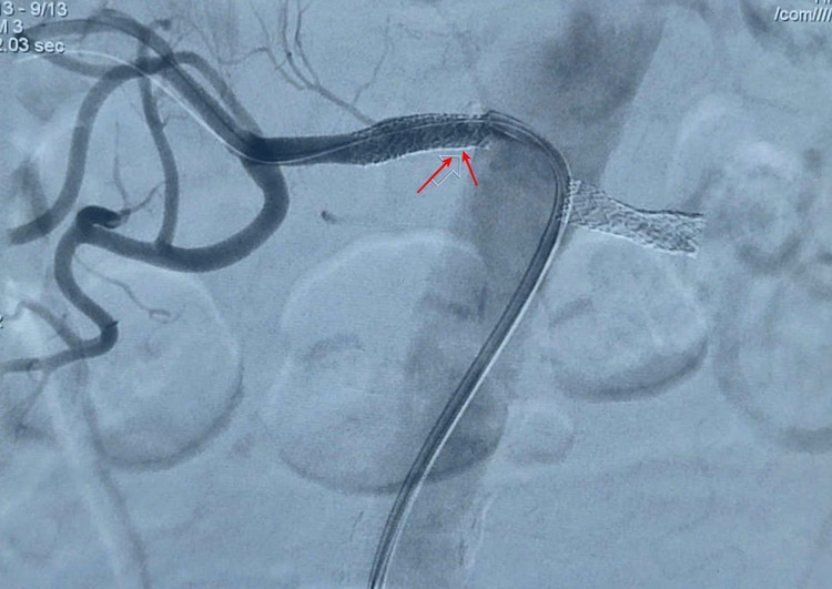 Hình ảnh can thiệp đặt stent động mạch thận 2 bên qua phim DSA - Ảnh BVCC stent-ha.jpg