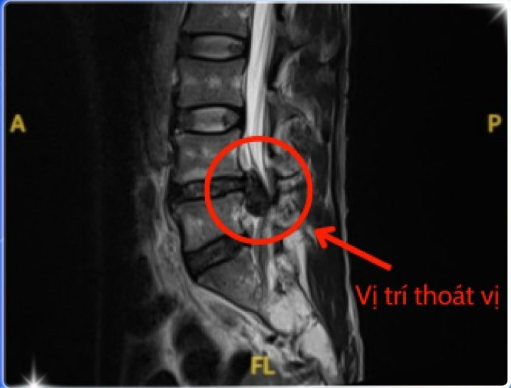 Hình ảnh MRI cho thấy vị trí thoát vị - Ảnh BVCC thoat-vi-tai-xe.jpg