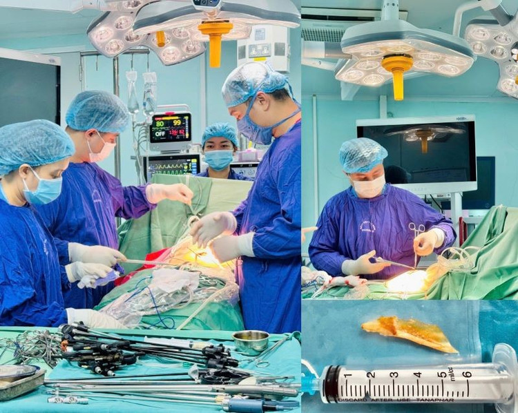 Ca phẫu thuật cho bệnh nhân - Ảnh BVCC thung-ruot-3-9269.jpg