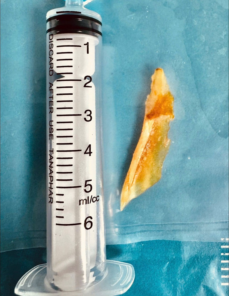 Xương cá dài 5 cm đã được lấy ra - Ảnh BVCC thung-ruot-1.jpg