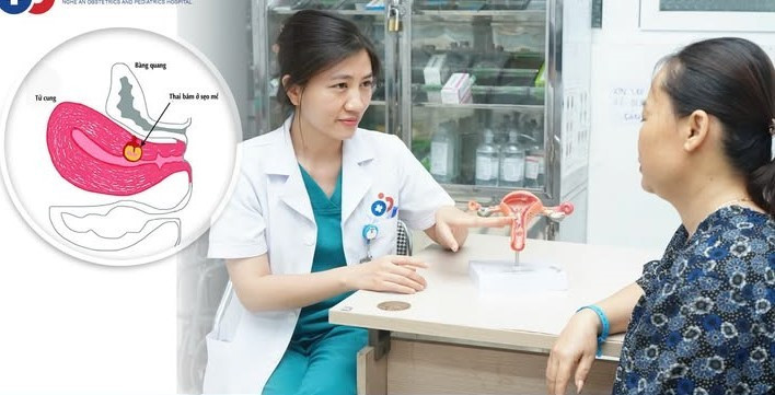 Tư vấn cho bệnh nhân mang thai trên sẹo mổ - Ảnh BVCC giu-tu-cung.jpg