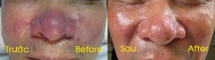Bệnh trứng cá đỏ trước và sau điều trị - Ảnh BVCC image.jpg
