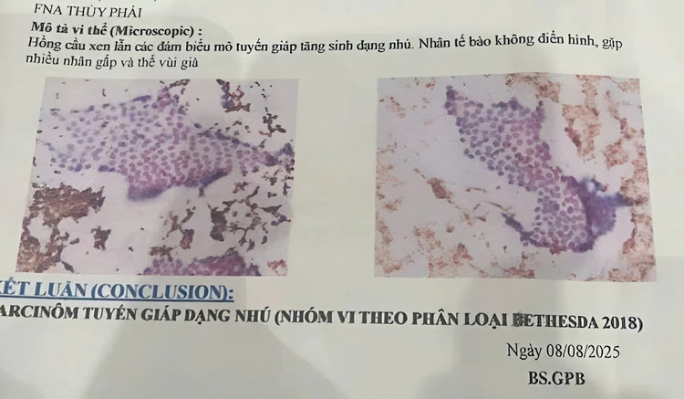 Kết quả chọc hút tế bào tuyến giáp, ghi nhận có tế bào ác tính (carcinoma giáp nhú) tuyen-giap-k.jpg
